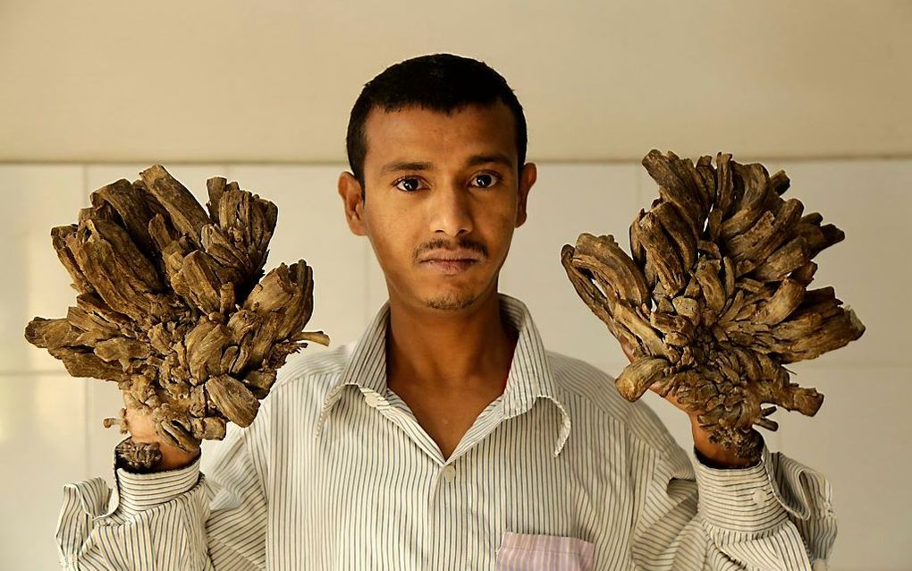 Abul Bajandra (25) uit Bangladesh heeft een zeer zeldzame erfelijke huidaandoening. beeld EPA