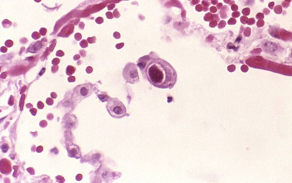 Het cytomegalovirus (CMV) is een risicofactor voor het ontwikkelen van diabetes type 2. Op deze elektronenmicroscopische opname een door CMV geïnfecteerde longcel. Foto Wikimedia/CDC