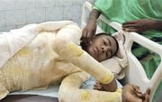 De 16-jarige Nitish Kumar liep bij een aanval door vermoedelijke hindoe-extremisten enorme brandwonden op. beeld Morning Star News