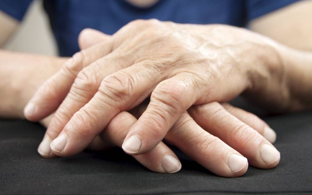 Reumatoïde artritis gaat gepaard met gewrichtsontstekingen en vergroeiingen. beeld Istock