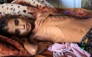 Humanitaire crisis in Jemen. beeld AFP, ESSA AHMED