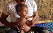 Moaz Ali Mohammed (2) een ondervoed kind in Jemen. beeld AFP
