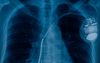 Zuurstof lijkt geschikt als energiebron voor een pacemaker. beeld iStock