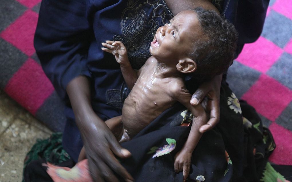 Een zes maanden oude baby met ernstige ondervoeding huilt in de armen van zijn moeder in het Referral Hospital in Shahemene, Ethiopië. beeld EPA, Irada Humbatova