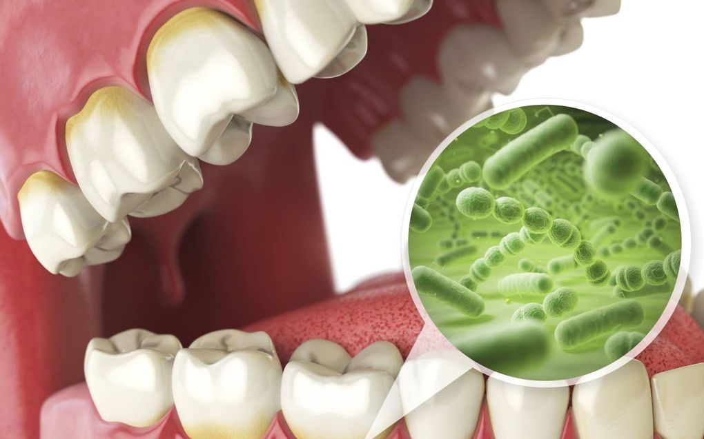 Tandplakbacteriën kunnen bij ontstoken tandvlees in de bloedbaan terechtkomen en zo bijdragen aan een hele reeks aandoeningen, waaronder reuma, diabetes, hart- en vaatziekten en kanker. beeld iStock