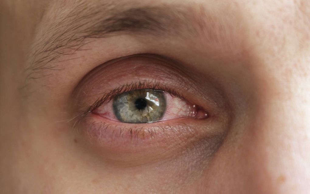 Corona is soms af te lezen aan het oog