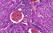 Kankercellen. beeld iStock