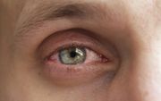Een coronabesmetting kan een rood oog veroorzaken. beeld iStock