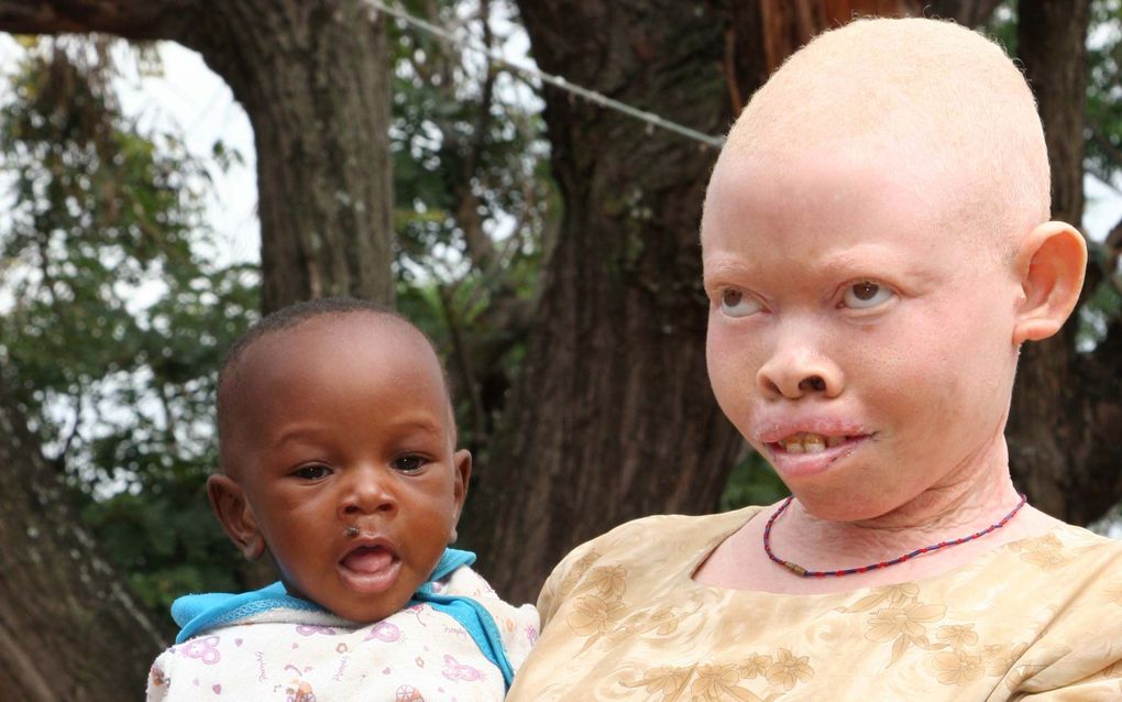 DAR ES SALAAM – Albino’s komen relatief veel voor in Afrika. Landen als Tanzania en Nigeria kennen de hoogste concentraties ter wereld. Veel van hen lopen al rond hun dertigste huidkanker op, doordat ze niet bestand zijn tegen de straling van de zon. Daar