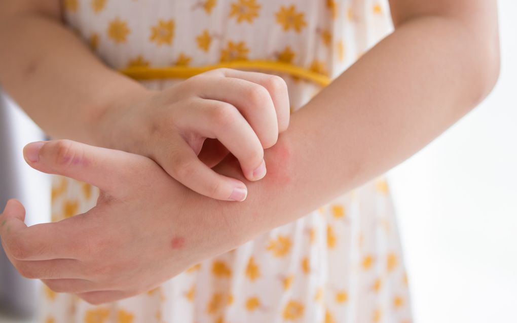 Meisje met jeukende armen. beeld iStock