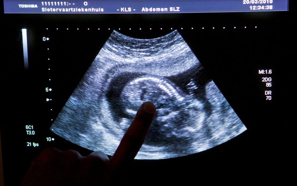 Ouders laten een zwangerschap soms afbreken omdat ze liever een jongetje of een meisje hadden gewild. Dat signaleren verloskundigen in podcast De Koningswens. Foto: een echo in het Slotervaartziekenhuis in Amsterdam. beeld ANP, Koen Suyk