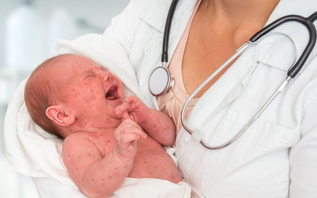 Een kindje met mazelen. Sinds begin dit jaar zijn er zeker 64 gevallen van mazelen gemeld in Nederland. beeld iStock