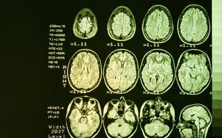 MRI-beelden van hersenen. Gele hersenen op zwarte achtergrond. 