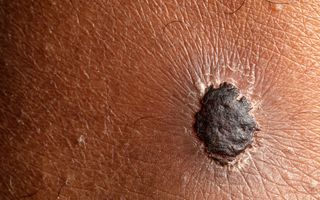 Bruine, dikke plek op huidweefsel.