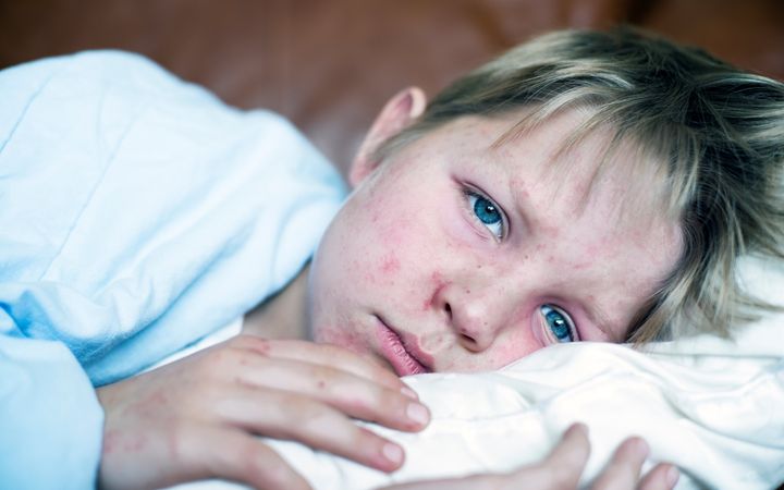 Een jongetje ligt op bed. Op zijn gezicht zijn rode bultjes te zien. 