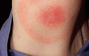 Een rode ring –erythema migrans–na de beet van een teek, is een bewijs van besmetting met de borreliabacterie, maar treedt bij infectie helaas slechts in de helft van de gevallen op. Foto Bert Jansen