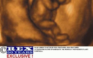Een actieve foetus van twaalf weken oud in de baarmoeder. De foetus probeert stapjes te maken op dezelfde manier als een pasgeboren baby van wie de voetjes een plat oppervlak raken. Foto Prof. Campbell