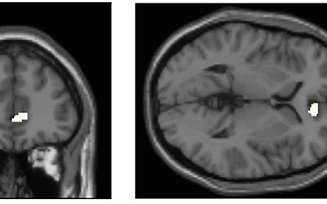 Bij mensen die multitasken is de grijze stof minder in één hersenkern, de cortex cingularis anterior. beeld University of Sussex