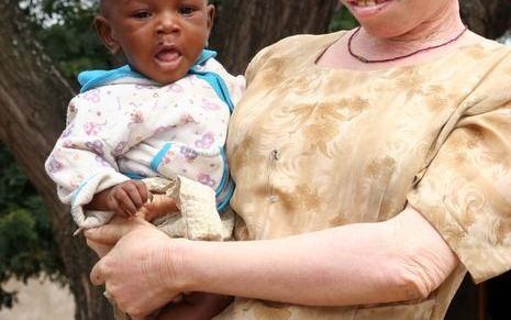Albino’s komen relatief veel voor in Afrika. Landen als Tanzania en Nigeria kennen de hoogste concentraties ter wereld. Veel van hen lopen al rond hun dertigste huidkanker op, doordat ze niet bestand zijn tegen de straling van de zon. Daarnaast ondervinde
