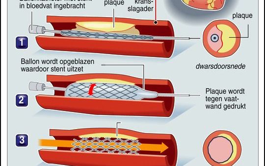 ROTTERDAM – De eerste volledig biologisch afbreekbare stent is vorige week geplaatst bij een patiënt met een dichtgeslibde kransslagader. De graphic geeft informatie over gewone, niet-biologisch afbreekbare stents. Graphic ANP