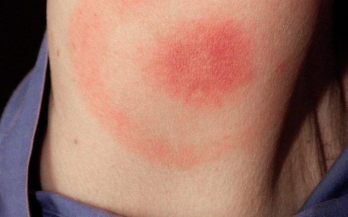 De rode ring (erythema migrans) die optreedt bij ongeveer de helft van de patiënten die door een tekenbeet zijn besmet met de bacterie Borrelia burgdorferi. De rode ring of een rode verdikking rond de beetplaats is een zeker bewijs van besmetting. Als er 