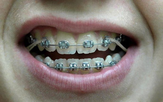 Een behandeling bij de orthodontist wordt vanaf vandaag 13 procent duurder. Foto ANP