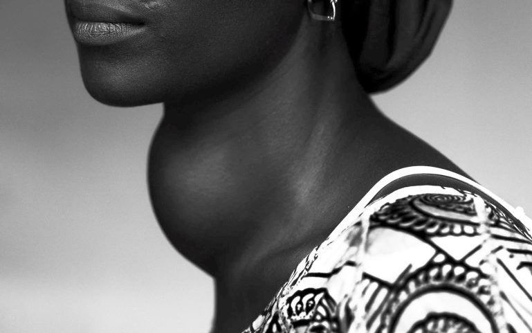 Een portret van een vrouw met een gezwel bij haar hals is een bekroonde foto van Stephan Vanfleteren. Foto EPA