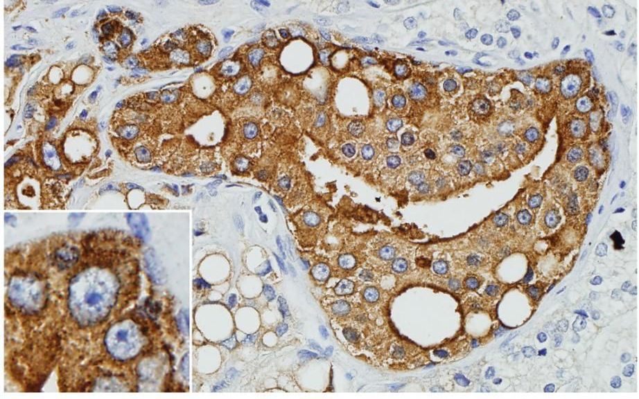 Kwaadaardige prostaatkankercellen die eiwitten van het XMRV-virus aanmaken, kleuren bruin bij weefselonderzoek. Celkernen zijn donkerblauw. Foto University of Utah