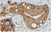 Kwaadaardige prostaatkankercellen die eiwitten van het XMRV-virus aanmaken, kleuren bruin bij weefselonderzoek. Celkernen zijn donkerblauw. Foto University of Utah